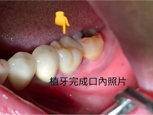 植牙案例-張正忠醫師 植牙案例-張正忠醫師