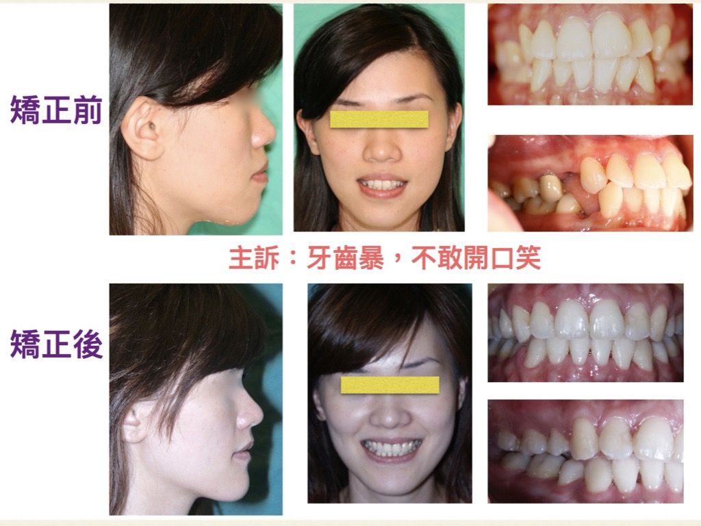 矯正案例－鍾思遠醫師