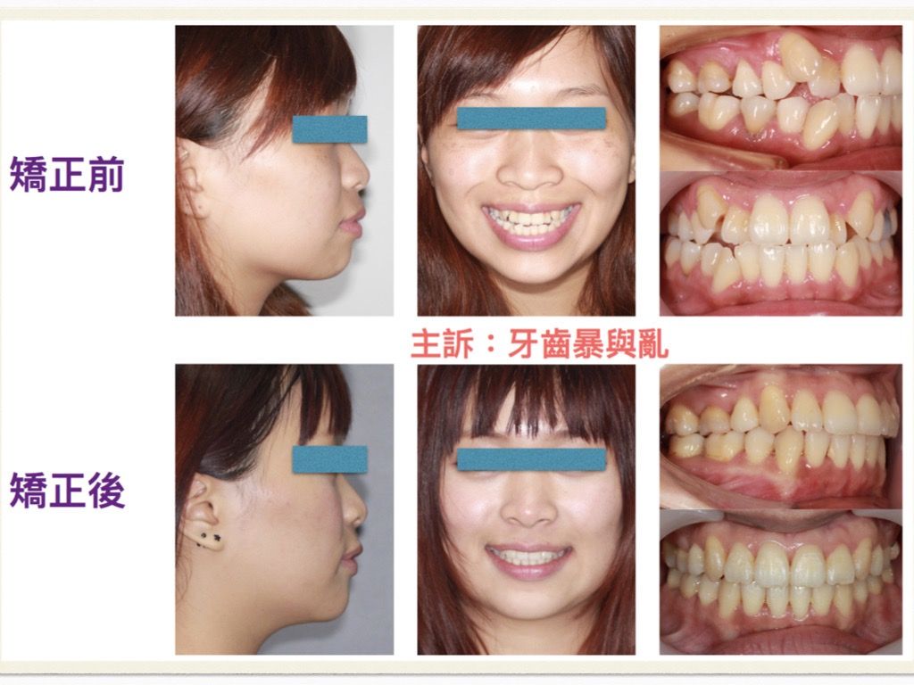 矯正案例－鍾思遠醫師