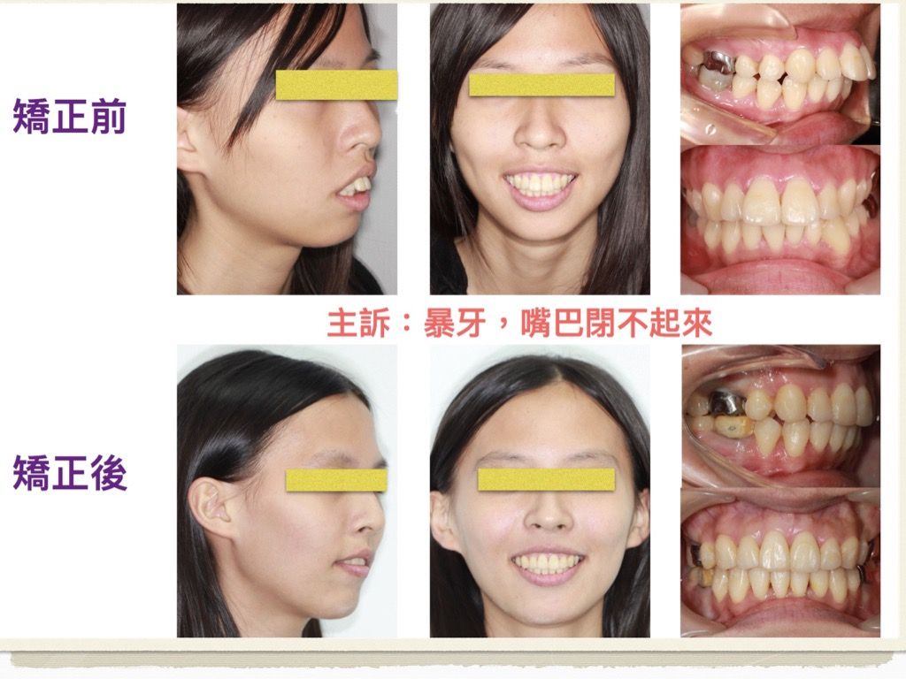 矯正案例－鍾思遠醫師