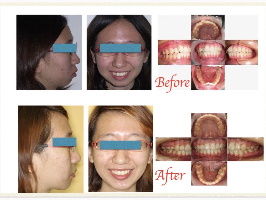 矯正案例－鍾思遠醫師