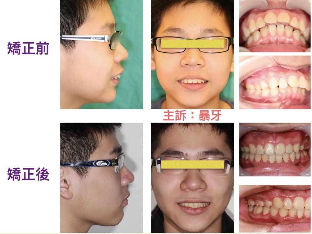 矯正案例－鍾思遠醫師