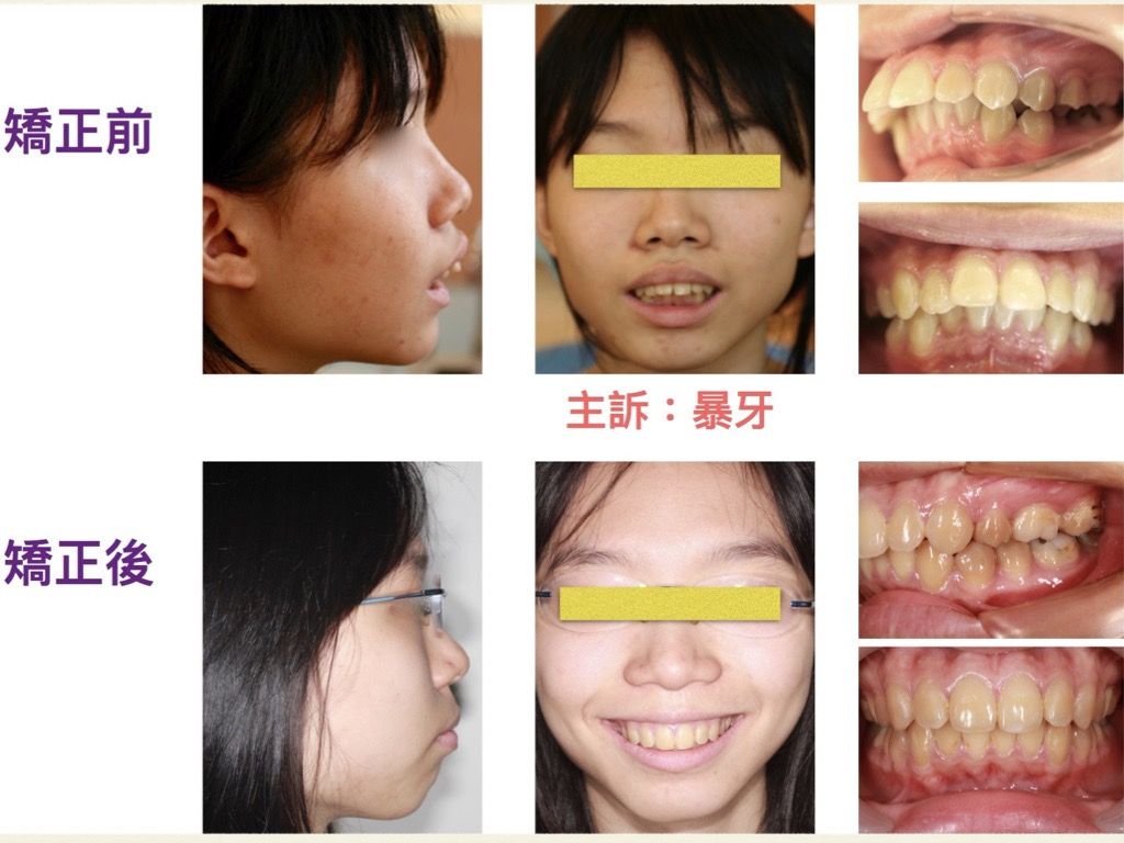 矯正案例－鍾思遠醫師
