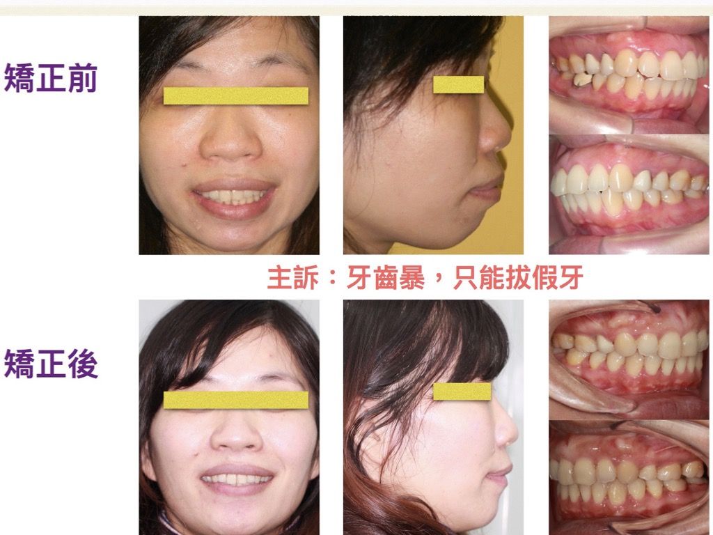 矯正案例－鍾思遠醫師