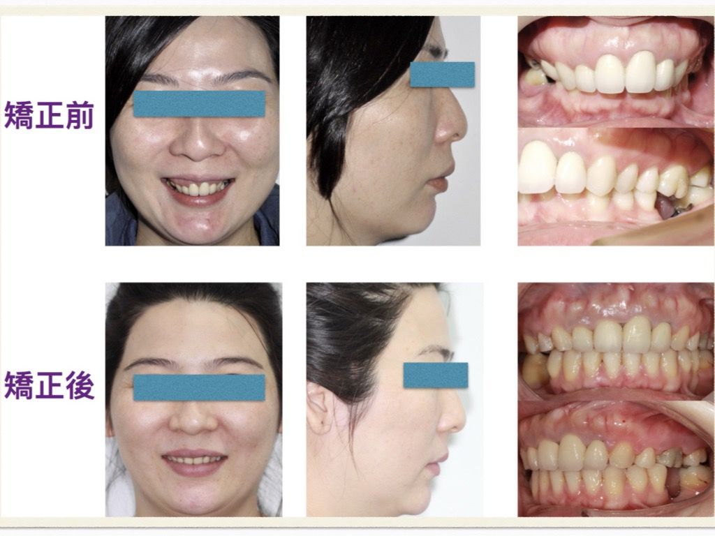 矯正案例－鍾思遠醫師