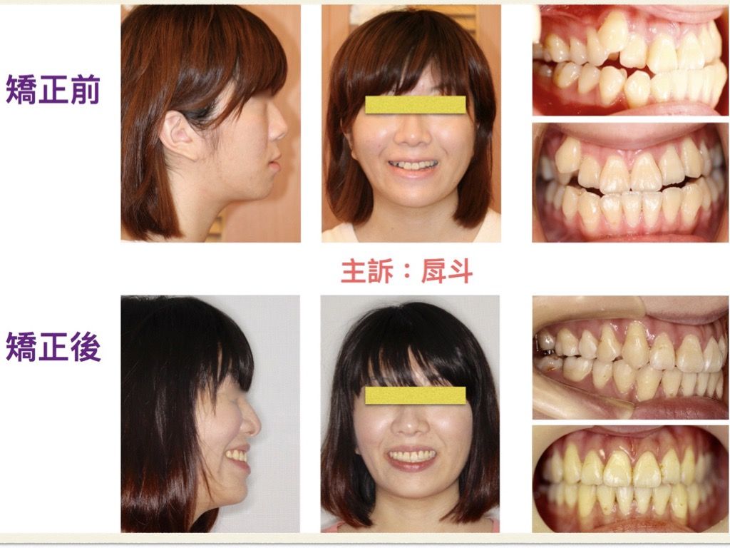 矯正案例－鍾思遠醫師