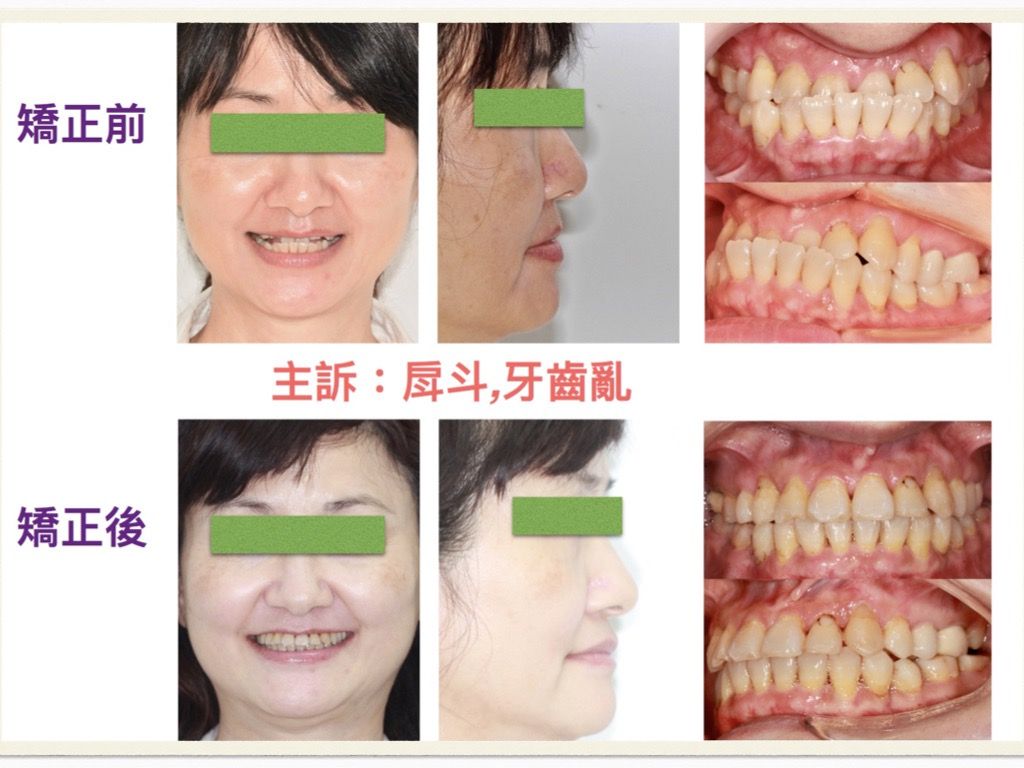 矯正案例－鍾思遠醫師