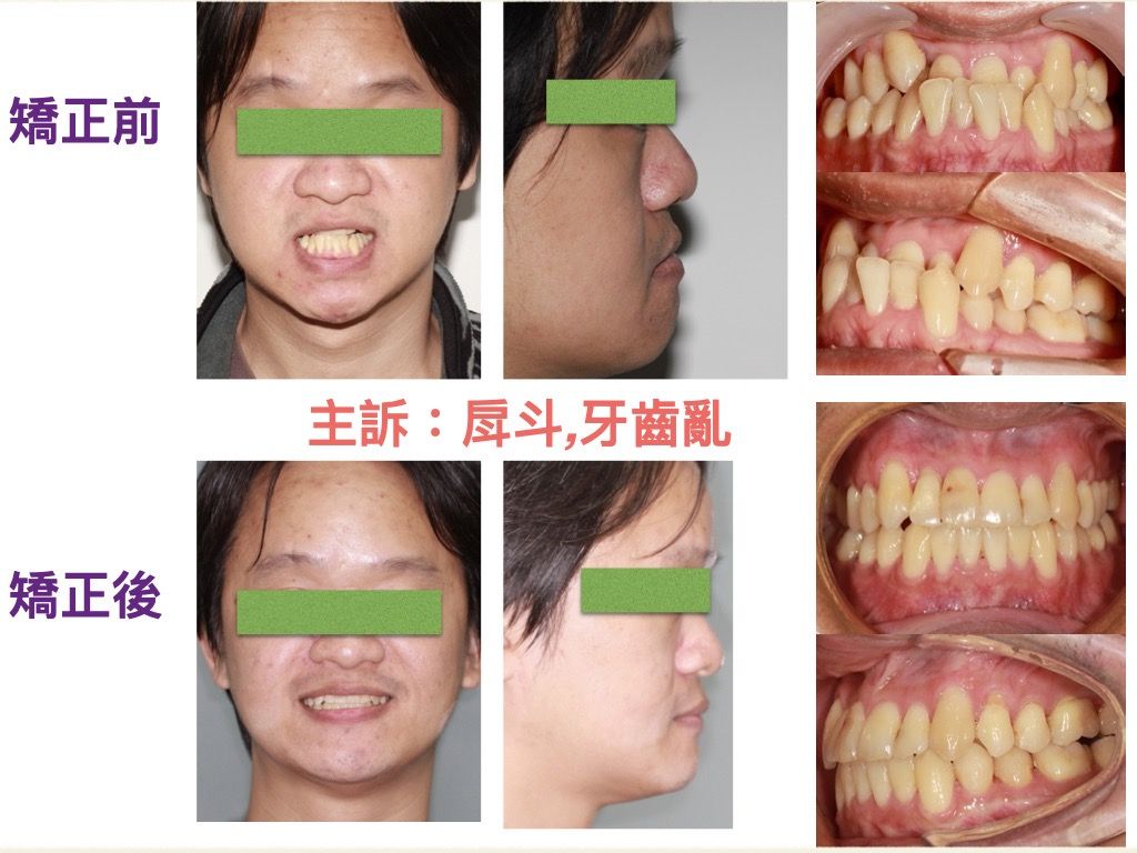矯正案例－鍾思遠醫師