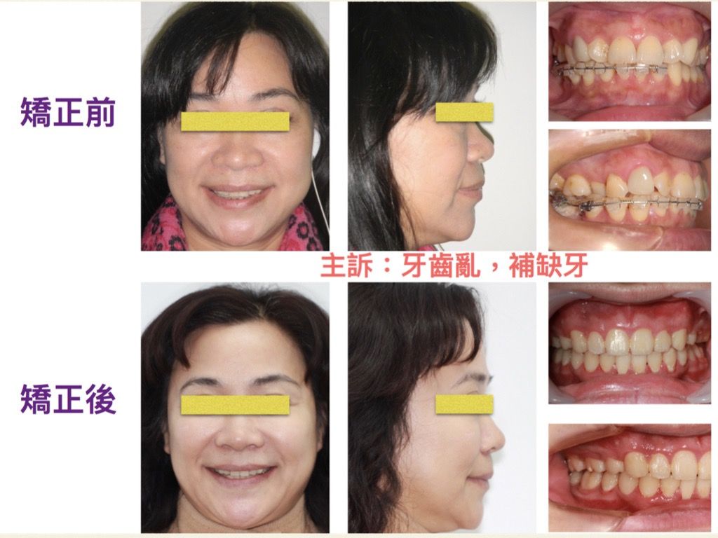 矯正案例－鍾思遠醫師