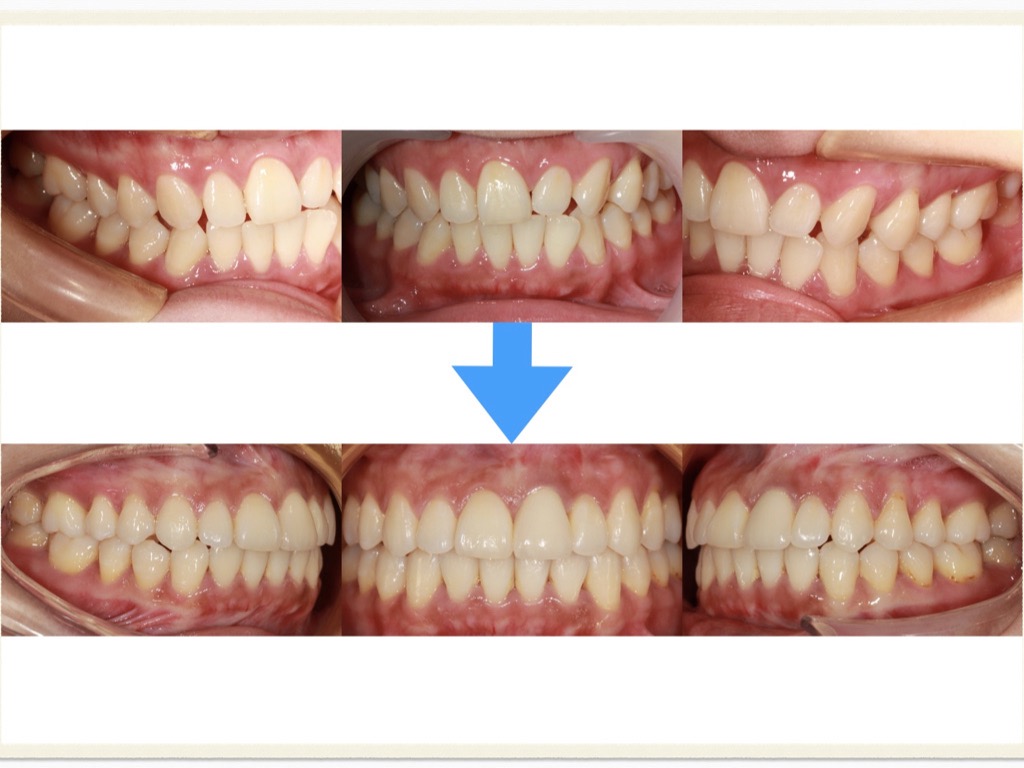 矯正案例－鍾思遠醫師