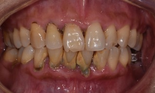 微創牙周病治療－陳珮儀醫師