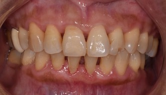 微創牙周病治療－陳珮儀醫師