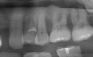 微創牙周再生-陳珮儀醫師