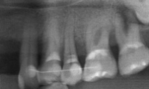 微創牙周再生-陳珮儀醫師