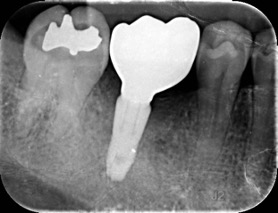 牙周補骨植牙－陳珮儀醫師