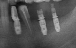 多顆植牙補骨重建-陳珮儀醫師