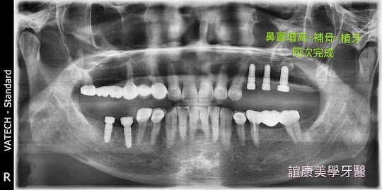 植牙案例－張正忠醫師