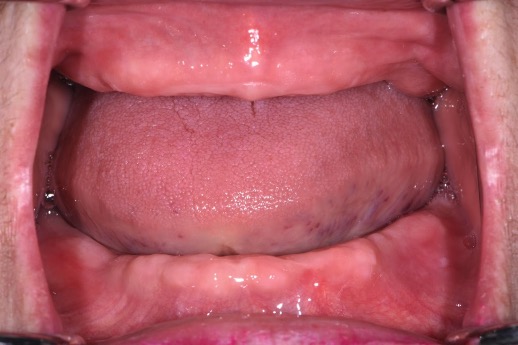 全口活動義齒－林錫奎醫師