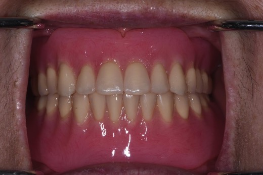 全口活動義齒－林錫奎醫師