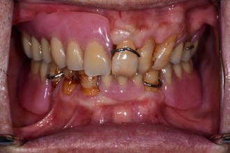 局部活動義齒－林錫奎醫師