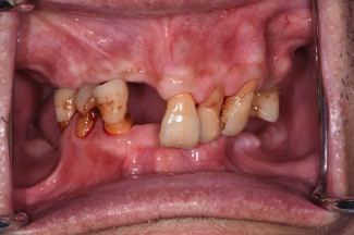 局部活動義齒－林錫奎醫師