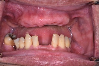 局部活動義齒－林錫奎醫師