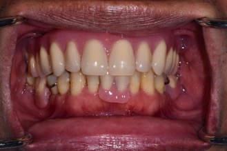 局部活動義齒－林錫奎醫師