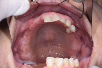 下顎植牙兩顆－林錫奎醫師