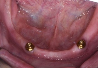 下顎植牙兩顆－林錫奎醫師