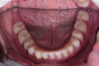 下顎植牙兩顆－林錫奎醫師