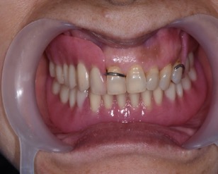 下顎植牙兩顆－林錫奎醫師