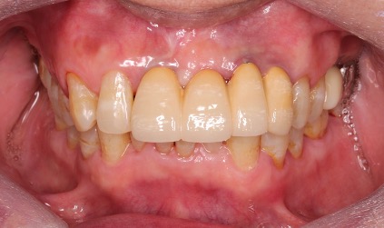 前牙植牙－林錫奎醫師