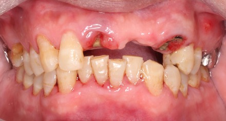 前牙植牙－林錫奎醫師