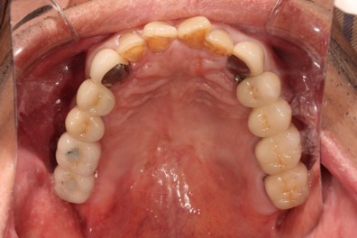 後牙植牙－林錫奎醫師