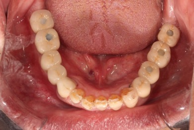 後牙植牙－林錫奎醫師