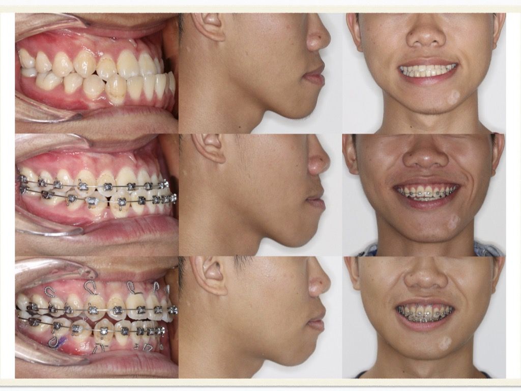 正顎手術－鍾思遠醫師