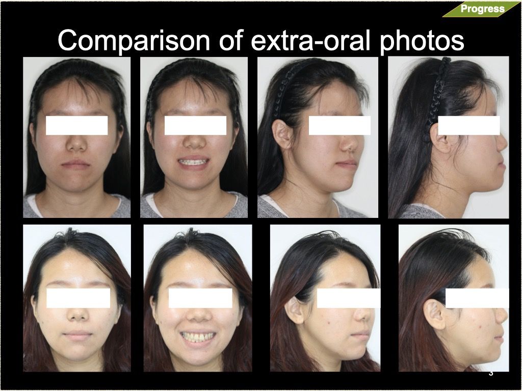 正顎手術－鍾思遠醫師