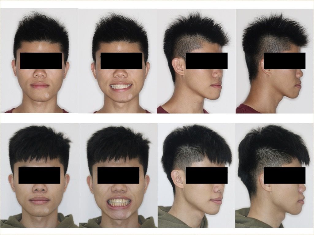 正顎手術－鍾思遠醫師