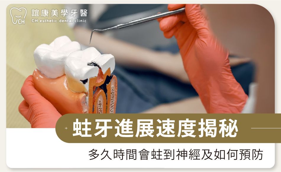 蛀牙進展速度揭秘：多久時間會蛀到神經及如何預防