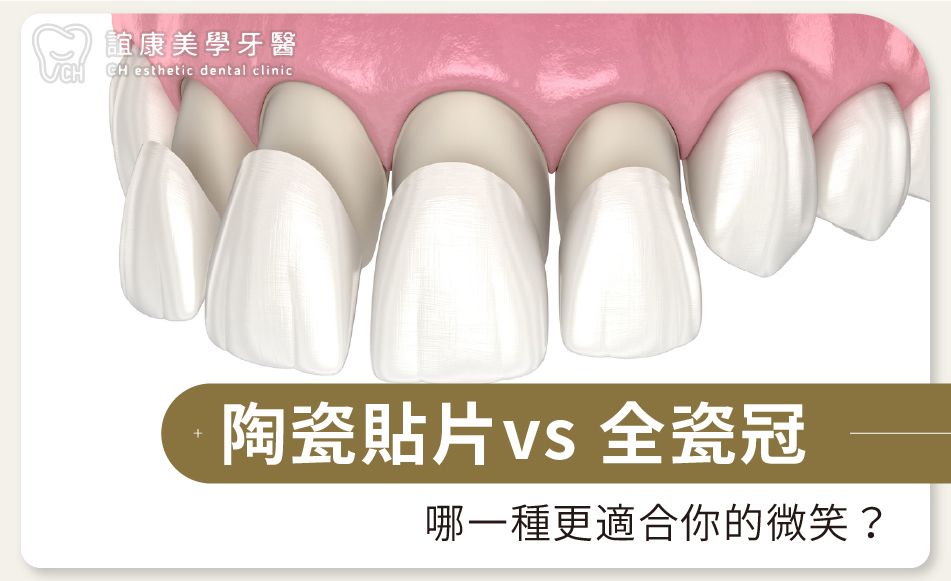 陶瓷貼片vs全瓷冠：哪一種更適合你的微笑？