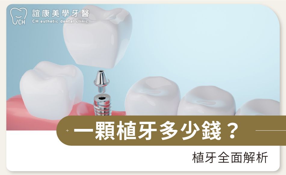 一顆植牙多少錢？植牙全面解析