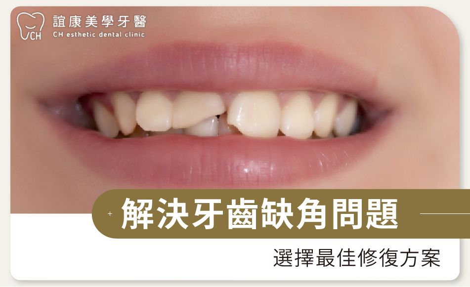解決牙齒缺角問題：選擇最佳修復方案