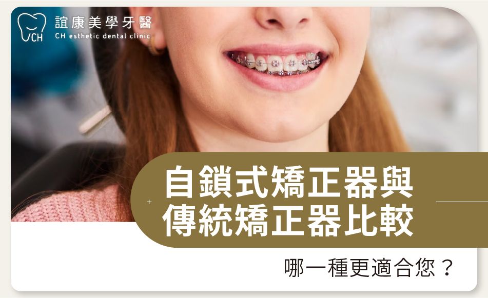 自鎖式矯正器與傳統矯正器比較：哪一種更適合您？