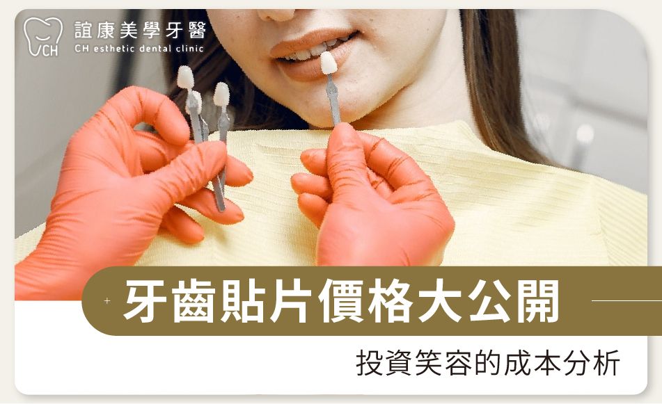 牙齒貼片價格大公開：投資笑容的成本分析