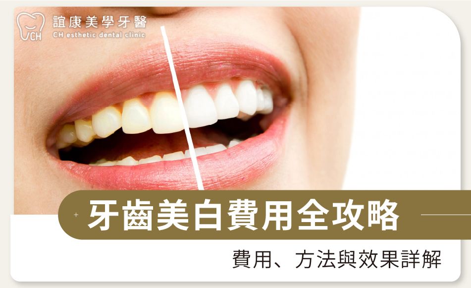 牙齒美白費用全攻略：費用、方法與效果詳解