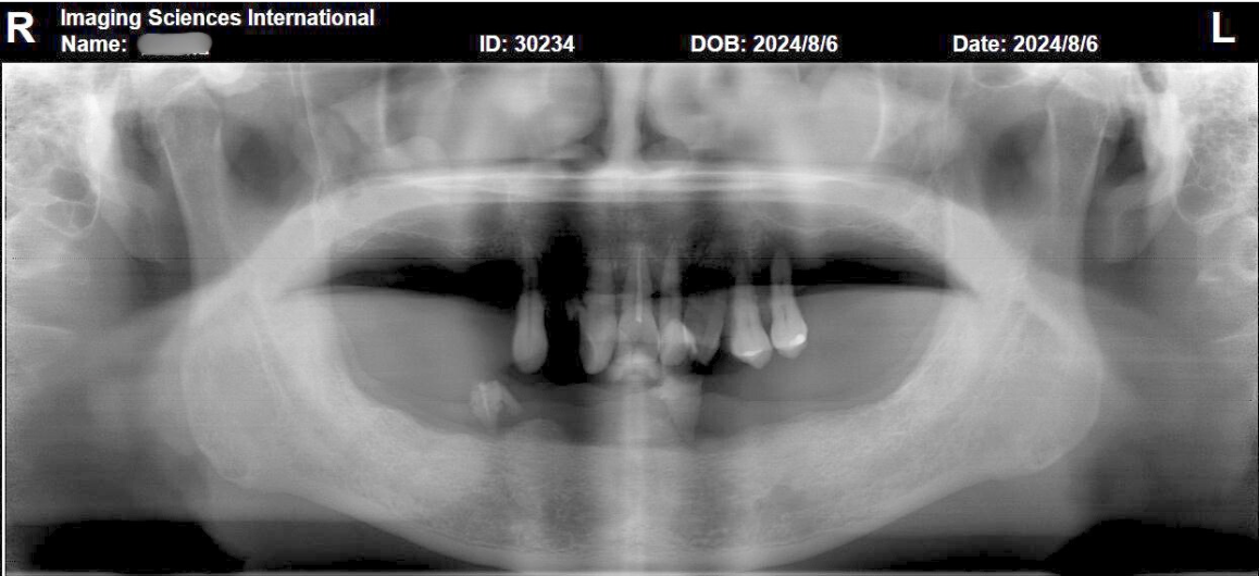 數位植牙是什麼? 數位植牙是什麼?