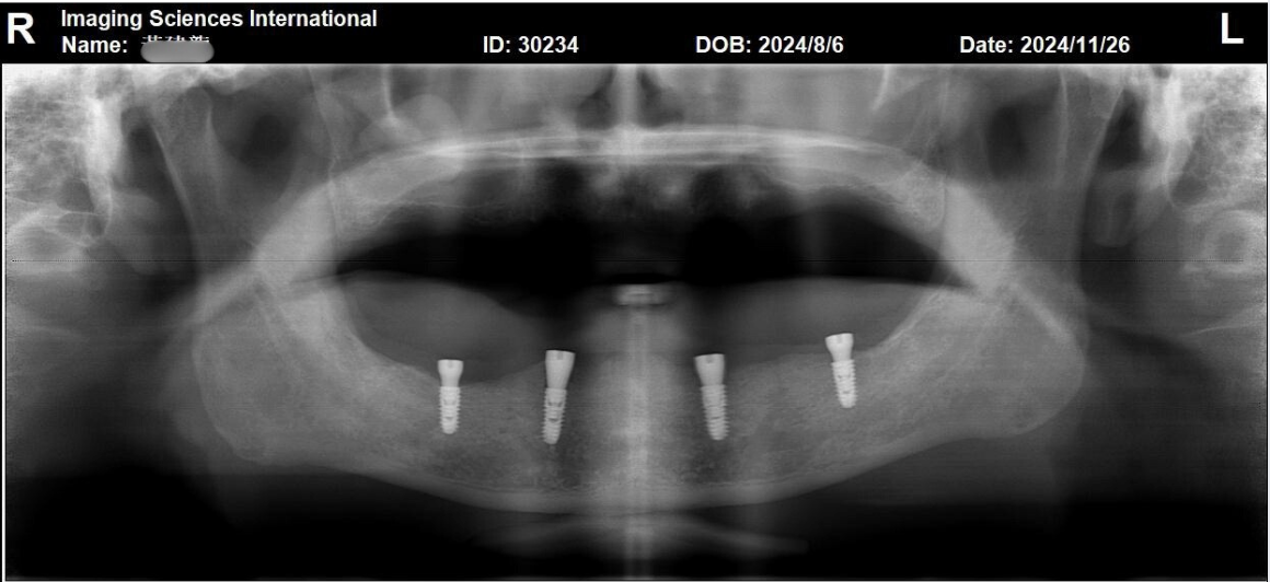 數位植牙是什麼? 數位植牙是什麼?
