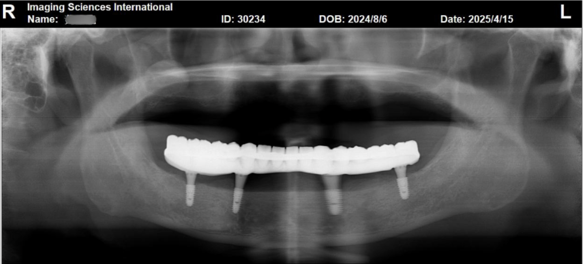 數位植牙是什麼? 數位植牙是什麼?